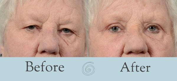 Eyelid Surgery Before and After 8 - Front
