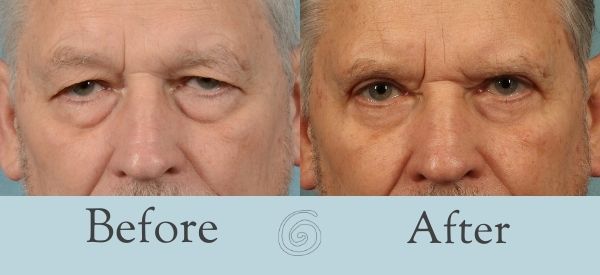 Eyelid Surgery Before and After 9 - Front