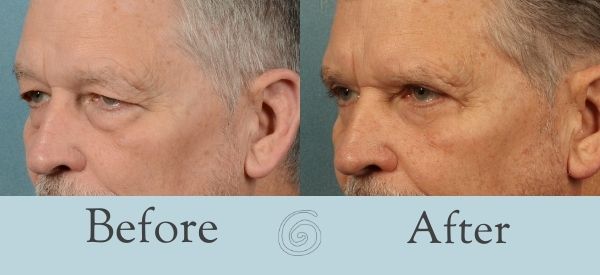 Eyelid Surgery Before and After 9 - Side