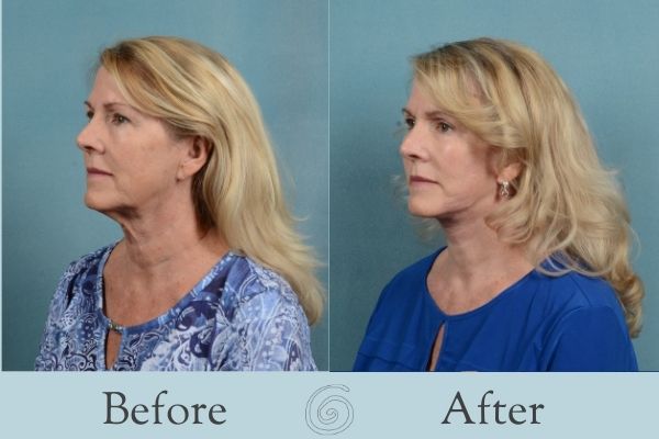 Facelift Before and After 2 - Side