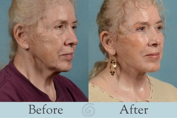 Facelift Before and After 4 - Side