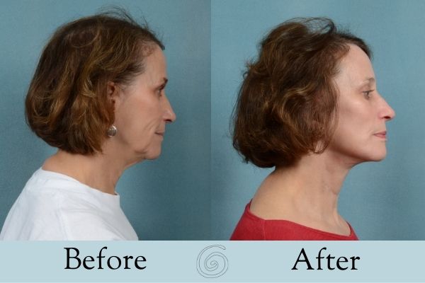 Facelift Before and After 5 - Side