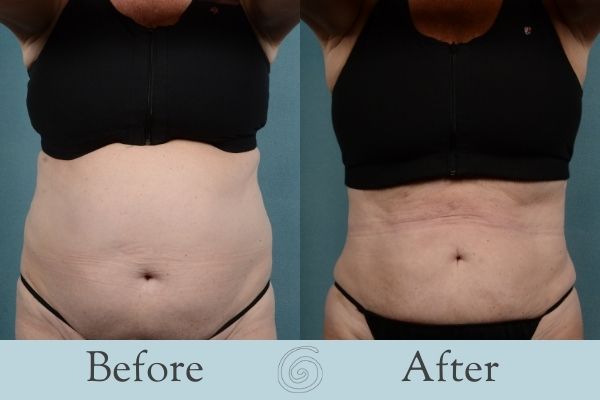 Liposuction Before and After 1 - Front