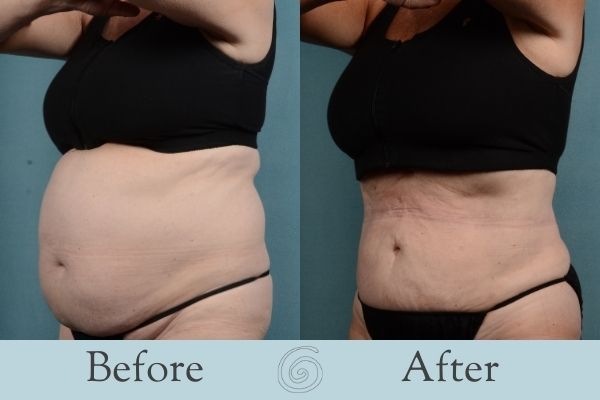 Liposuction Before and After 1 - Side