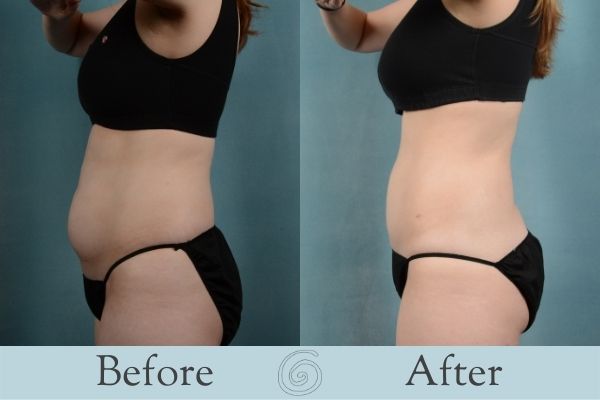 Liposuction Before and After 2 - Side