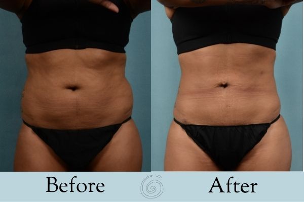Liposuction Before and After 3 _ Front
