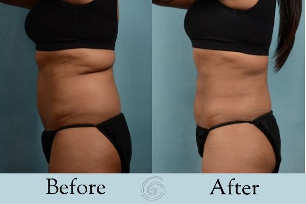 Liposuction Before and After 3 _ Side