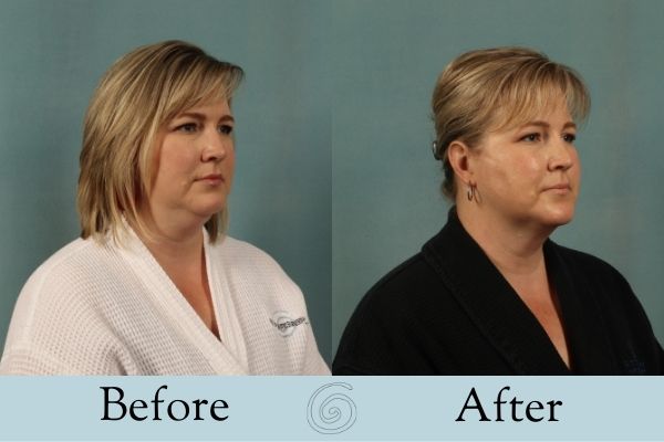 Liposuction Before and After 4 - Front