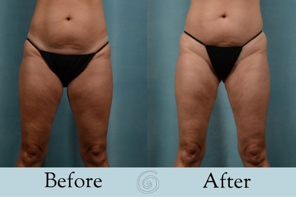 Liposuction Before and After 5 - Front