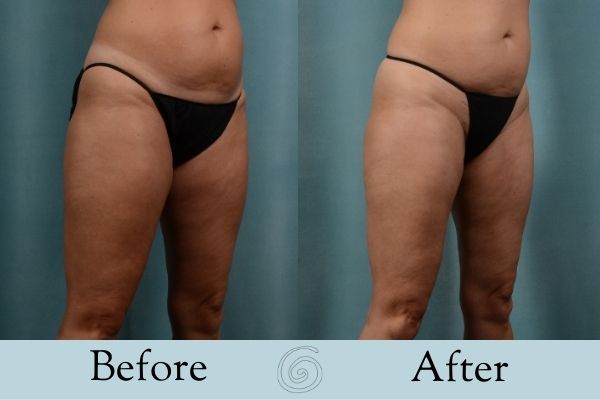 Liposuction Before and After 5 - Side