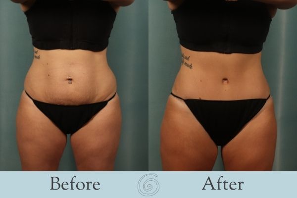 Tummy Tuck Before and After 15 - Front