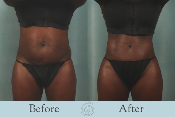 Tummy Tuck Before and After 16 - Front
