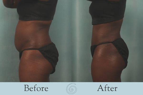 Tummy Tuck Before and After 16 - Side