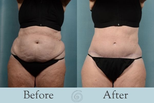 Tummy Tuck Before and After 17 - Front