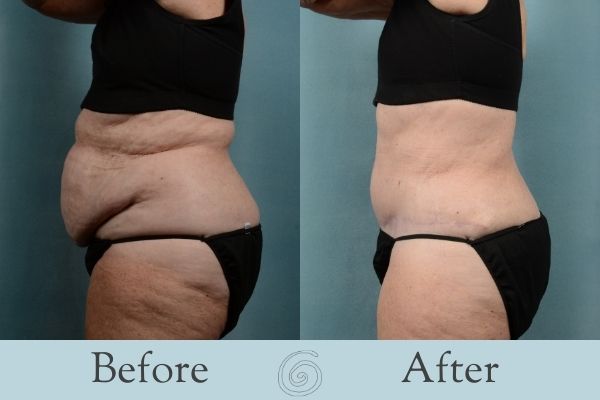 Tummy Tuck Before and After 17 - Side