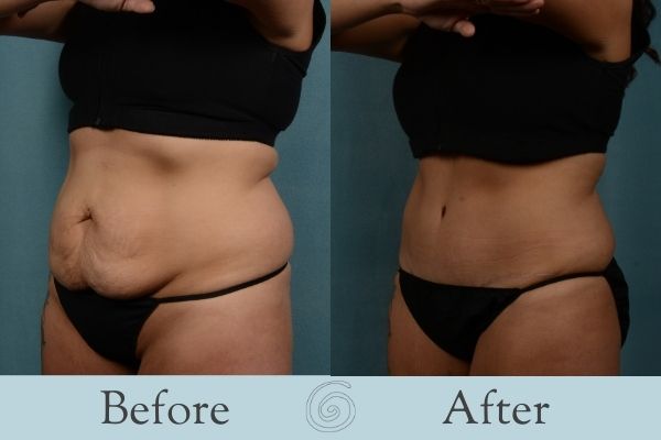 Tummy Tuck Before and After 19- Front