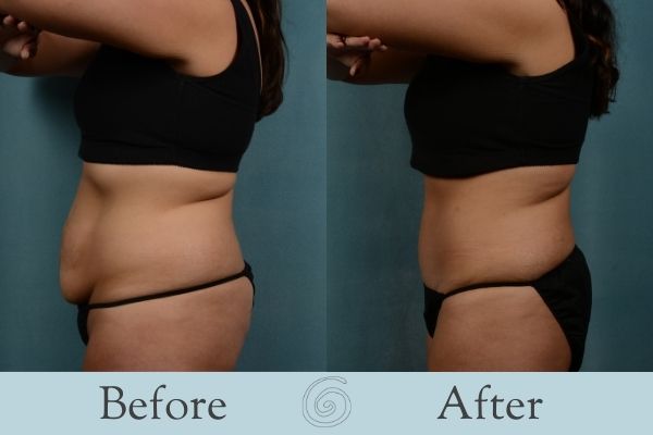 Tummy Tuck Before and After 19 - Side