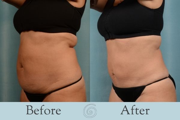 Tummy Tuck Before and After 20 - Side