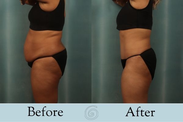 Tummy Tuck Before and After 22 - Side