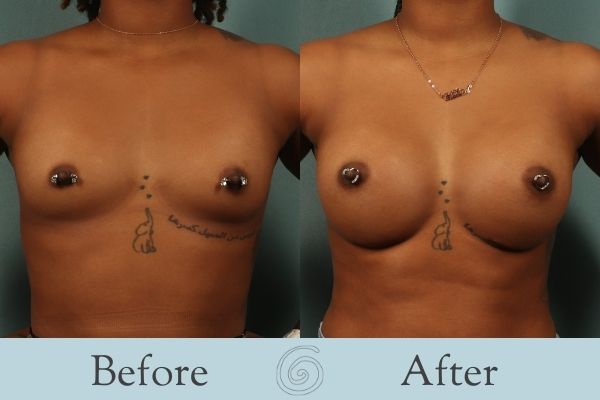Breast Augmentation Before and After 27 - Front
