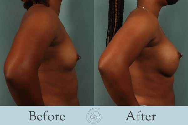 Breast Augmentation Before and After 27 - Side