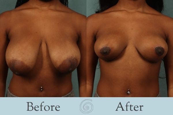 Breast Reduction Before and After 12 - Front