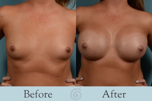 Breast Augmentation Before and After 11 _ Front