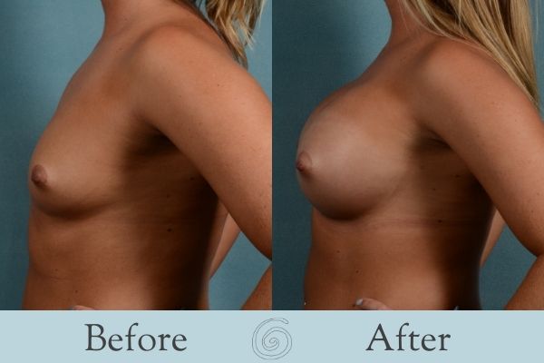 Breast Augmentation Before and After 11 _ Side