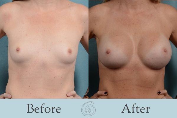 Breast Augmentation Before and After 16 - Front
