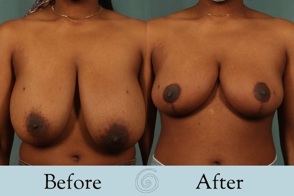 Breast Reduction Before and After 13 - Front