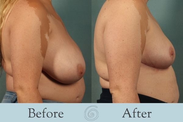 Breast Reduction Before and After 15 - Side
