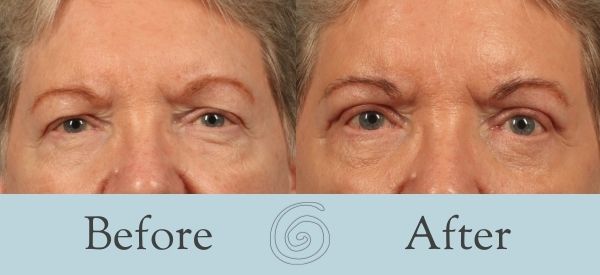 Eyelid Surgery Before and After 21 - Front