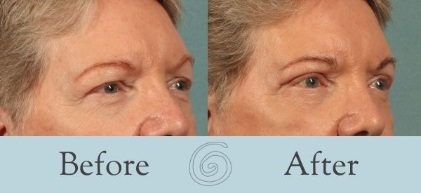 Eyelid Surgery Before and After 21 - Side