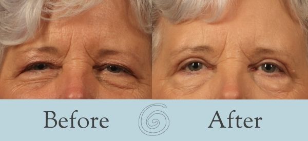 Eyelid Surgery Before and After 22 - Front