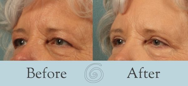 Eyelid Surgery Before and After 22 - Side