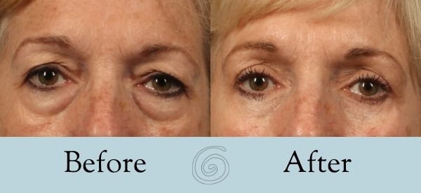 Eyelid Surgery Before and After 23 - Front