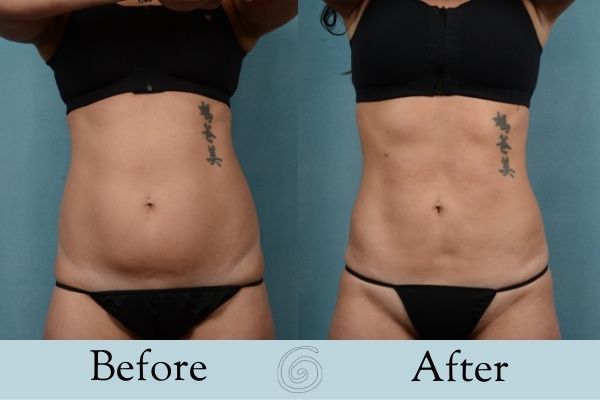 Liposuction Before and After 6 - Front