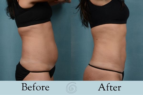 Liposuction Before and After 6 - Side