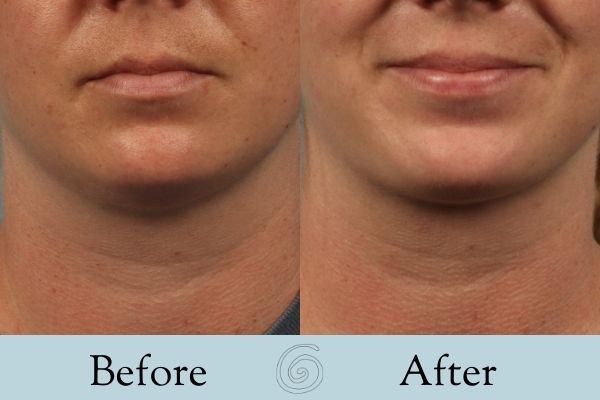 Liposuction Before and After 7 - Front