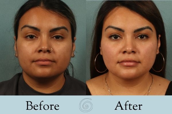 Liposuction Before and After 8 - Front