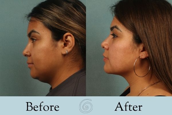 Liposuction Before and After 8 - Side