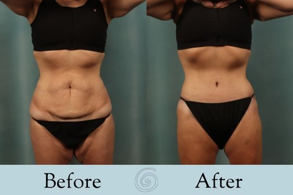Tummy Tuck Before and After 18 - Front
