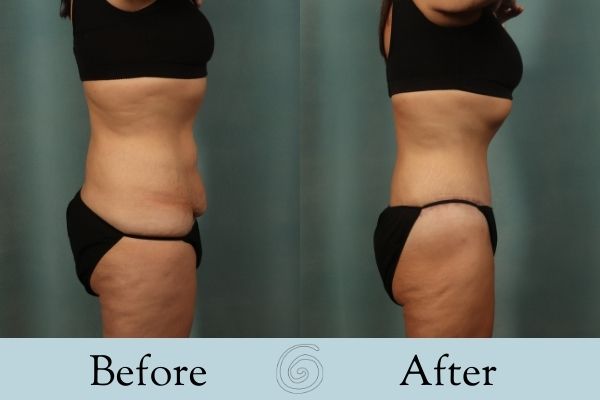 Tummy Tuck Before and After 18 - Side