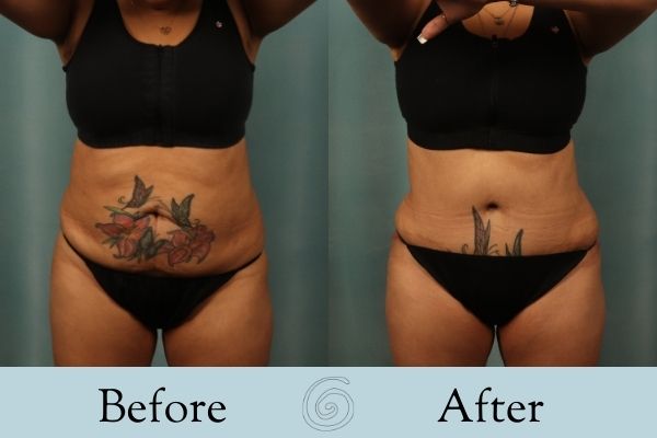Tummy Tuck Before and After 23 - Front