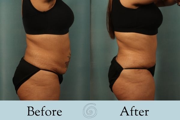 Tummy Tuck Before and After 23 - Side