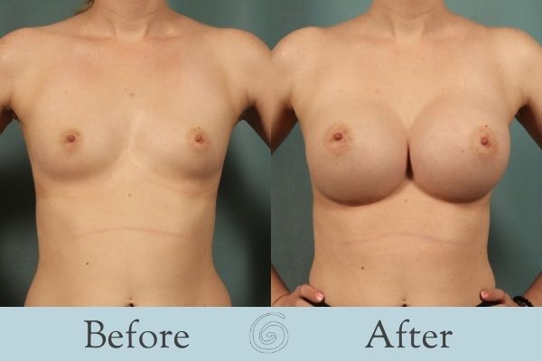 Breast Augmentation Before and After 14 - Front