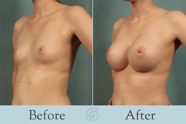 Breast Augmentation Before and After 14 - Side