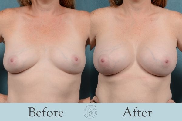 Breast Augmentation Before and After 18 _ Front
