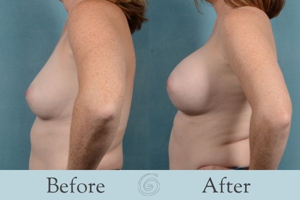 Breast Augmentation Before and After 18 _ Side