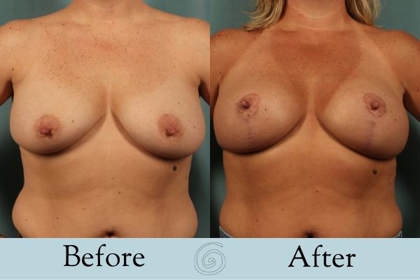 Breast Augmentation and Lift Before and After 1 _ Front